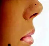  کوچک کردن سریع بینی در خانه با زنجبیل در 10 روز