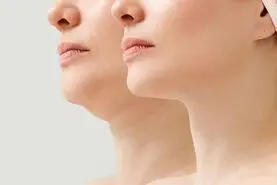 راه های از بین بردن غبغب به روش های خانگی
