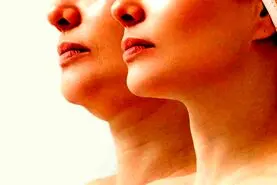 راه های از بین بردن غبغب به روش های خانگی